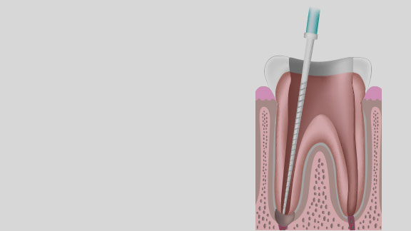 root canal illustration gloucester ma
