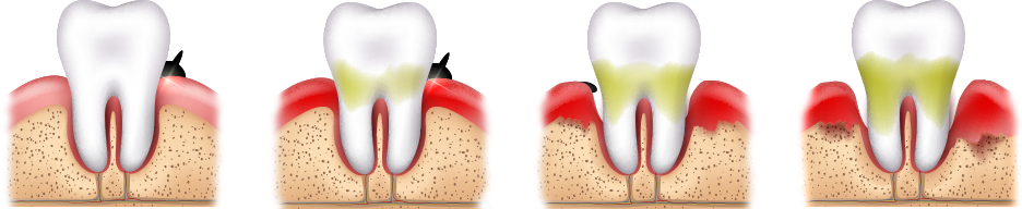gum recession process