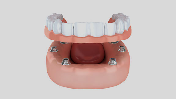 implant supported dentures model gloucester ma