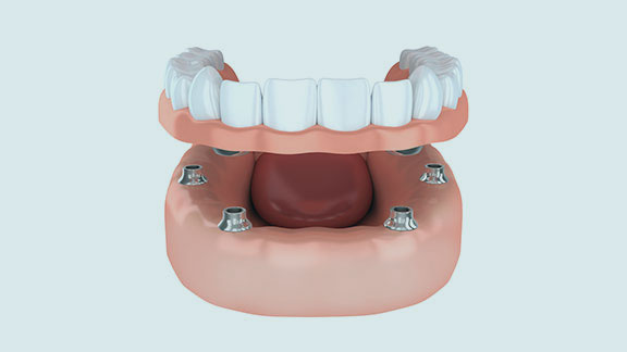 implant supported dentures model gloucester ma