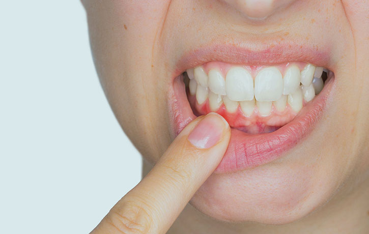 gum disease example