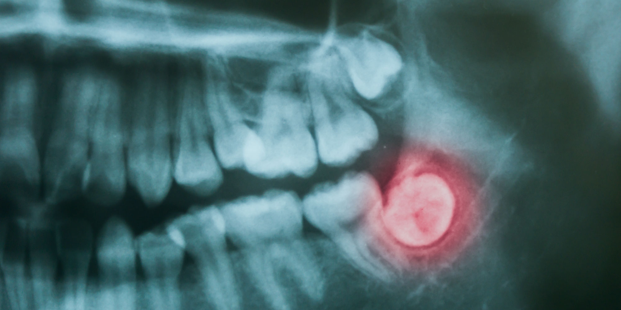 toothextractionxray Soheil Samiei D.M.D., P.C