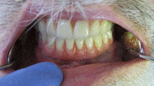 after dental implants