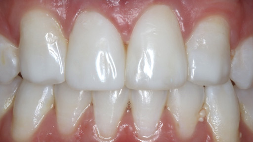 after porcelain veneers