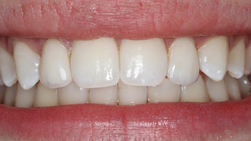 after porcelain veneers