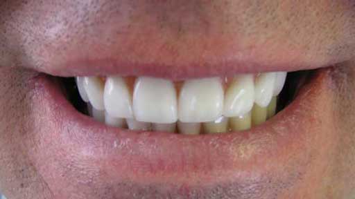 after porcelain veneers