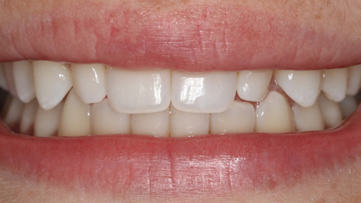 before Porcelain Veneers