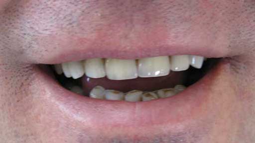 before Porcelain Veneers