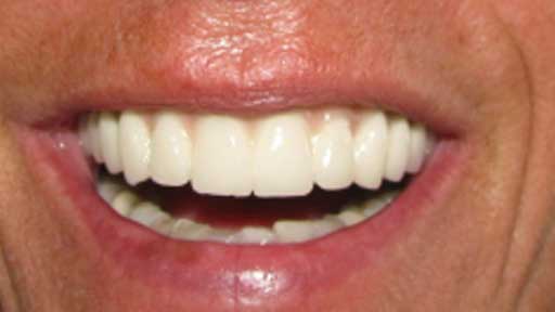 after dental implants